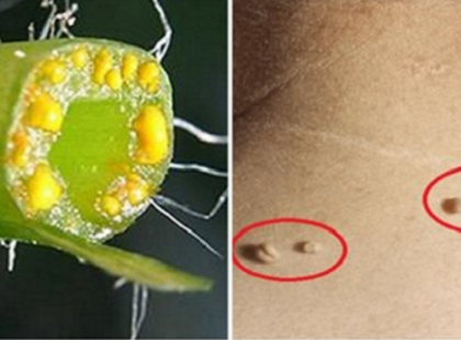 VANNAK BŐRKINÖVÉSEK RAJTAD? ÍGY SZABADULHATSZ MEG TŐLÜK VÉGLEG