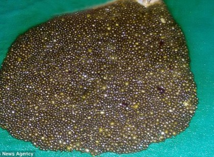 HASFÁJÁSRA PANASZKODOTT A NŐ. MIKOR AZ ORVOSOK MEGLÁTTÁK, MI OKOZZA, KIS HÍJÁN ELÁJULTAK.