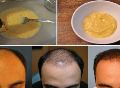 SÖRT ÉS BANÁNT KENT A HAJÁRA! 1 HÉT MÚLVA NEM HITT A SZEMÉNEK!