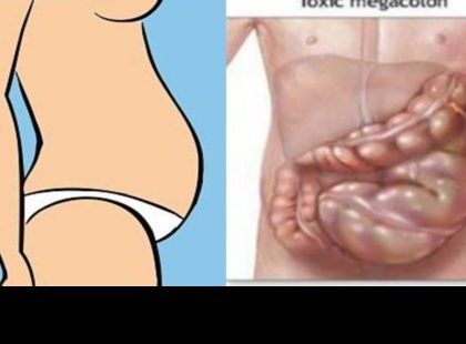 NEM VAGY KÖVÉR! A GYOMROD VAN FELFÚJÓDVA, ÍGY SZÜNTETHETED MEG!