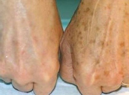 ÉSZREVETTE A BARNA FOLTOKAT A KEZÉN, AZTÁN ELTÜNTETTE ŐKET! EZZEL!