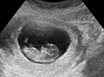 A TÍZÉVES KISLÁNYT MEGULTRAHANGOZTÁK A KÓRHÁZBAN - AZ ORVOSOK NEM AKARTAK HINNI A SZEMÜKNEK!