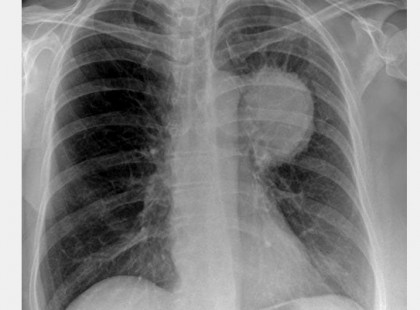 Édesanyám 1 hónap alatt gyógyult ki a tüdőrákból. Naponta 4 kiskanállal éhgyomorra..
