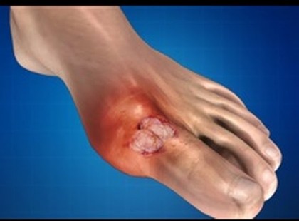 Ha sikerül kioldanod a húgysavat, eltűnik az ízületi fájdalom. Így csináld!