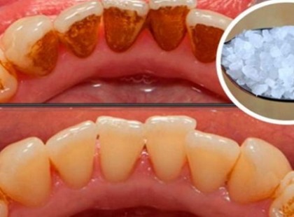 A legsárgább fogakat is kifehéríti ez a keverék, leszedi a fogkövet, és az nem is jön vissza