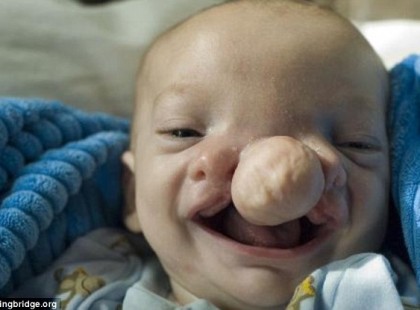 ÍGY NÉZ KI A MŰTÉTEK UTÁN A KISBABA, AKINEK A FEJÉN KÍVÜL NŐTT AZ AGYA!