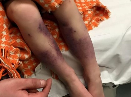 Amikor a kislány felébredt, lába tele volt zúzódásokkal… Hogy miért? Sokkolni fog!