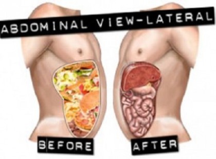 ELVÉGEZTE EZT AZ EGYSZERŰ MÓDSZERT, 8 KILÓ MÉREG TÁVOZOTT A BELEIBŐL