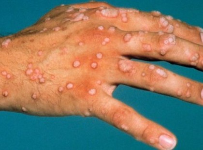 24 ÓRÁRA TEDD ENNEK A NÖVÉNYNEK A LEVÉT A SZEMÖLCSRE, ÉS LEESIK