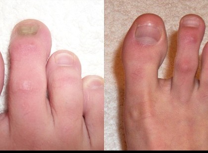 NEGYED ÓRA ALATT VISZLÁT A LÁBGOMBÁNAK EZZEL A SZERREL