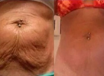 ÚJRA FESZES LESZ A HASADON A LÓGÓ BŐR ETTŐL! (VIDEÓ)