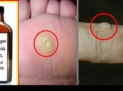 ITT A LEGJOBB MEGOLDÁS BŐRKINÖVÉSEK, SZEMÖLCSÖK ELTÜNTETÉSÉRE