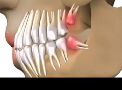 Nincs szükség implantátumra, a fogak 63 nap alatt kinőnek ezzel a technikával!