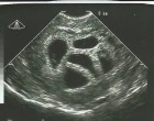 Amikor az orvosok meglátták az ultrahangos felvételt, abortuszt javasoltak… de ez az 5 testvér meg akart születni…