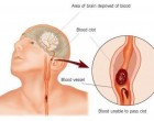 Még senki nem hallott a Stroke egyik legfontosabb előjeléről! Te legyél okosabb!