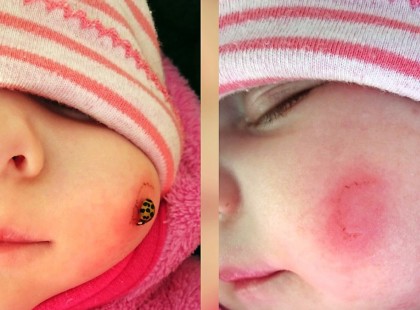 Három hónapos kislány arcát harlekinkatica harapdálta sebesre