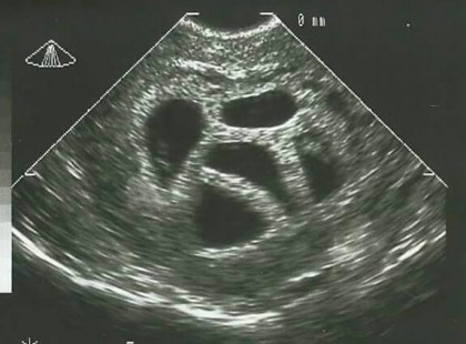 Amikor az orvosok meglátták az ultrahangos felvételt, abortuszt javasoltak… de ez az 5 testvér meg akart születni…