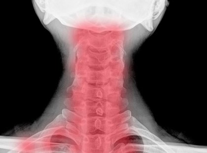 Nyaki spondilózis: a szédülés és a vállak zsibbadásának elsődleges oka!