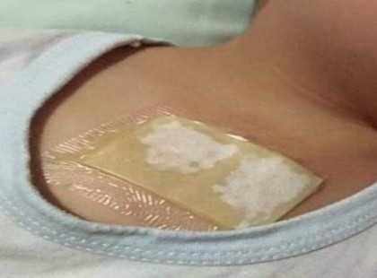 Egyetlen éjszaka meggyógyítja a légzőszervi betegségeket!Készítsd el ezt a gyömbéres borogatást!