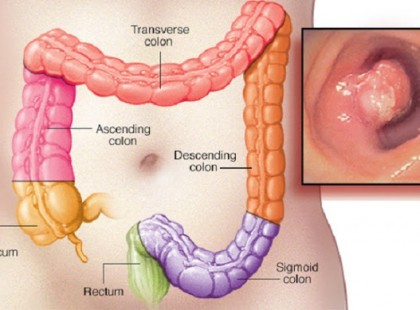 A végbélrák hét jele, amiről nem beszélünk, annyira zavarba ejtőek!