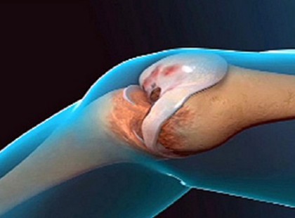 Az orvos szóhoz sem jutott! Ez a recept képes megújítani a térdet és az ízületeket!