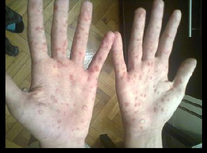 Felnőtteket is fertőz a kéz-, láb- és szájbetegség