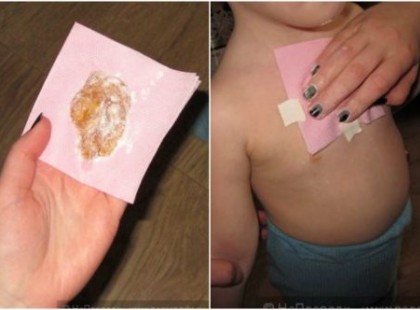 Gyömbéres pakolással egyetlen éjszaka alatt megszabadulhatsz a köhögéstől és a nyákos lerakódástól!