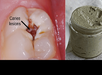 EZ A HÁZI KÉSZÍTÉSŰ FOGKRÉM MEGGYÓGYÍTJA A LYUKAS FOGAKAT, ELTÜNTETI A SZÚVASODÁST