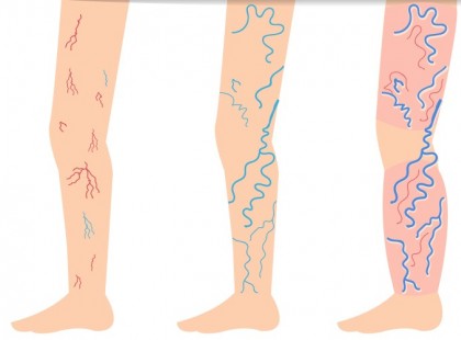 Édesanyám ezzel az olajjal tüntette el a visszerét pár hét alatt