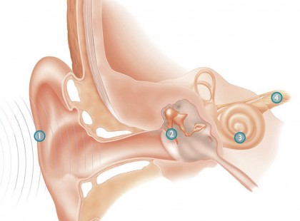 HA ROSSZ A HALLÁSOD, NINCS MÁS DOLGOD, MINT EZ, ÉS KÉT NAP MÚLVA VISSZATÉR A NORMÁL HALLÁSOD