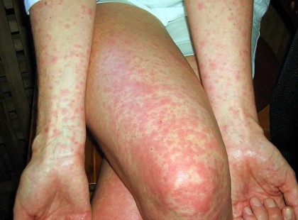 Ismét felütötte a fejét ez a fertőző betegség !Felnőtteket is fertőz a kéz-, láb- és szájbetegség