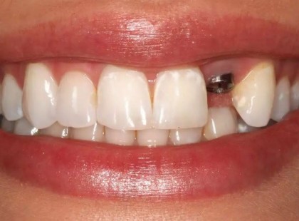 Fogpótlás állami támogatással! Szinte senki nem tud róla, pedig létezik!