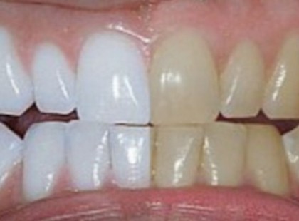 Fordítsd vissza az ínysorvadást és fehérítsd ki a fogaidat ezzel a házi fogkrémmel