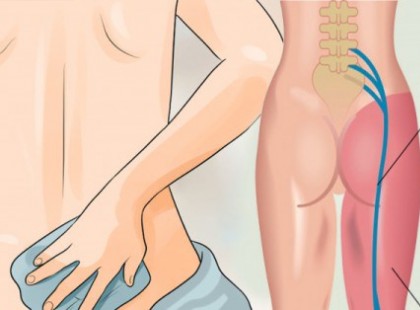 8 gyógymód isiászos fájdalom ellen, amit ki kell próbálnod, mielőtt még egy fájdalomcsillapítót bevennél!