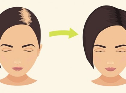 A szódabikarbóna villámgyorsan megállítja a hajhullást és gyorsítja a hajnövekedést!