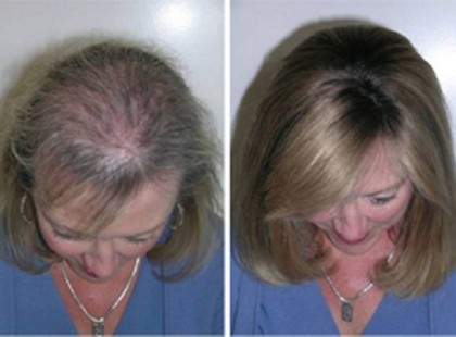 AZT TUDTAM, HOGY A RICINUSOLAJ HASHAJTÓ, DE NEM GONDOLTAM, HOGY EZ TÖRTÉNIK, HA A SZEMÖLDÖKÖMRE KENEM