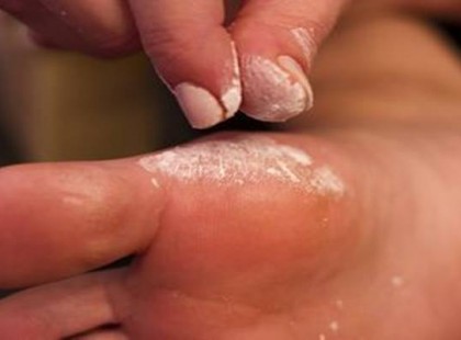 Csupán 2 dolog kell hozzá és azonnal vége a bőrkeményedésnek!