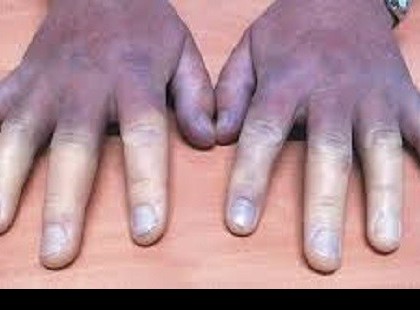 Mindig hideg a lábunk és a kezeink? Valószínűleg ez van a hátterében