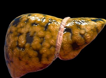 Mérgezőbb, mint az alkohol, mégis minden nap fogyasztjuk és megöli a májat!