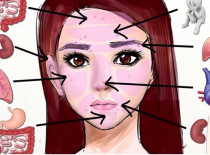 Nagyon nem mindegy, hol jött ki pattanás az arcodon. Mind más betegségre utalhat!