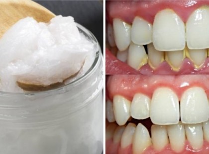 Nincs többé rossz szájszag, fogkő vagy baktérium a szájban -egy olyan dolog kell ehhez, ami biztos van otthon