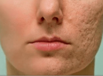 Dörzsöld ezt rá a ráncaidra, barna foltokra, sebhelyre és figyeld, ahogy percek alatt elhalványul. Az orvosom sem hitte el az eredményt!