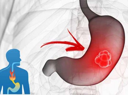 A gyomorrákot jelző kezdeti tünetek, amelyet soha ne hagyjuk figyelmen kívül!