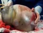 Az orvosok ikreket fedeztek fel az anya méhében… csak, hogy egy a 80.000-hez az esélye az ilyen születésnek…