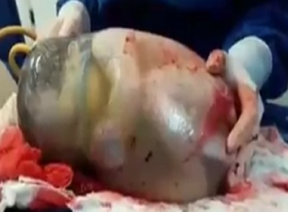 Az orvosok ikreket fedeztek fel az anya méhében… csak, hogy egy a 80.000-hez az esélye az ilyen születésnek…