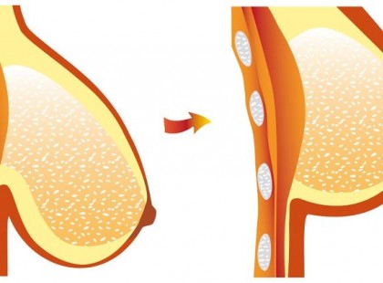 Ettől lesz lógós a nők melle! (Tippek, amivel megelőzheted)!