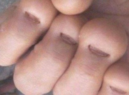 Ez a 40 éves férfi egyfolytában a körmeit rágta! Rossz szokásának végzetes következménye lett!