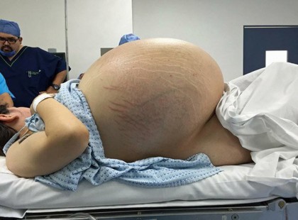Senki sem tudja megmondani miért ilyen óriási a hasa – szóhoz sem jutnak mikor meglátják a röntgen felvételt