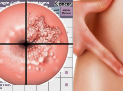 Ha ezt látod magadon, lehet hogy méhnyakrákod van