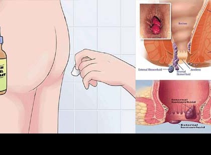 Az ORVOSOK még mindig nem találják rá a magyarázatot: ez az egyszerű készítmény gyógyítja az aranyeret, mindössze 20 perc alatt !!!